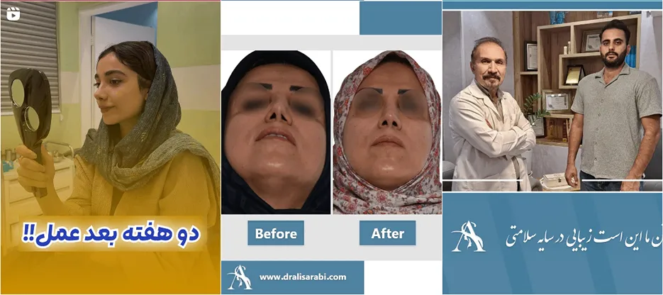نمونه کار دکتر سرابی از بهترین دکتر عمل بینی گوشتی در مشهد را در اینجا هم میتوانید مشاهده بفرمایید.