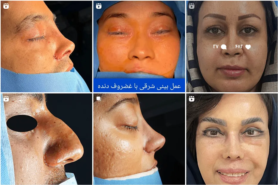 عمل بینی گوشتی در مشهد توسط دکتر غلامی قابل انجام است