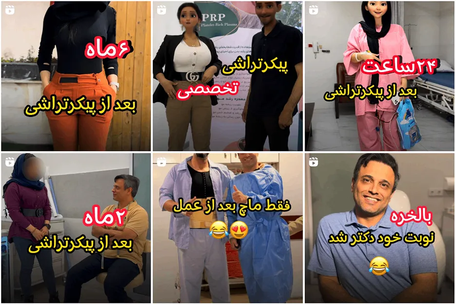 لیپوساکشن در مشهد توسط دکتر قربانزاده کاملا قابل انجام است