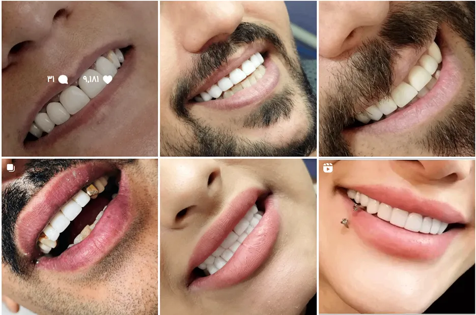 نمونه کار پروتز دندان را میتوانید در این تصویر مشاهده بفرمایید.