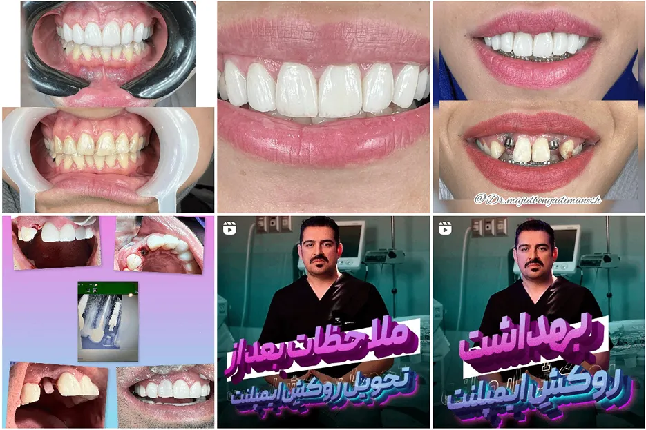 پروتز دندان مشهد توسط دکتر بنیادی منش کاملا قابل انجام است