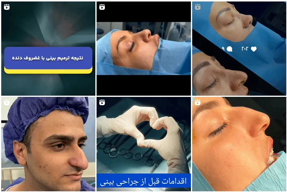 جراحی ترمیمی بینی در مشهد توس دکتر غلامی قابل انجام است