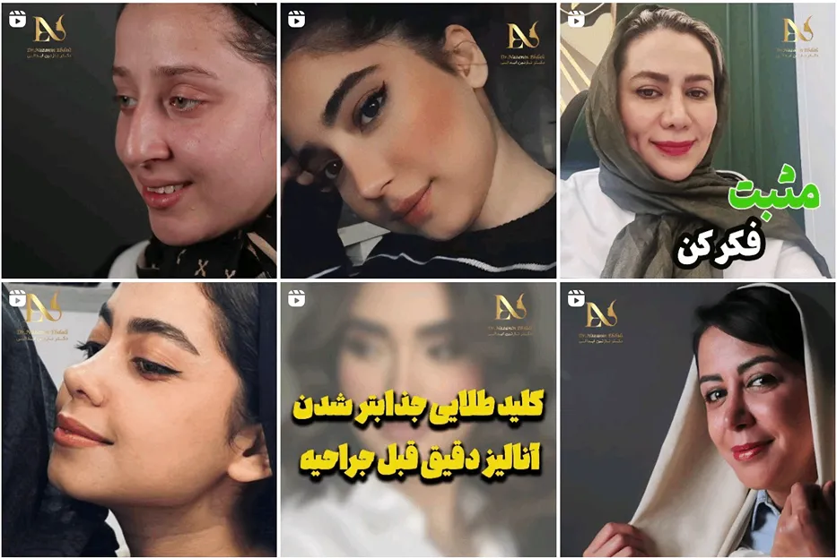 جراحی بینی گوشتی در مشهد توسط دکتر ابدالی قابل انجام است