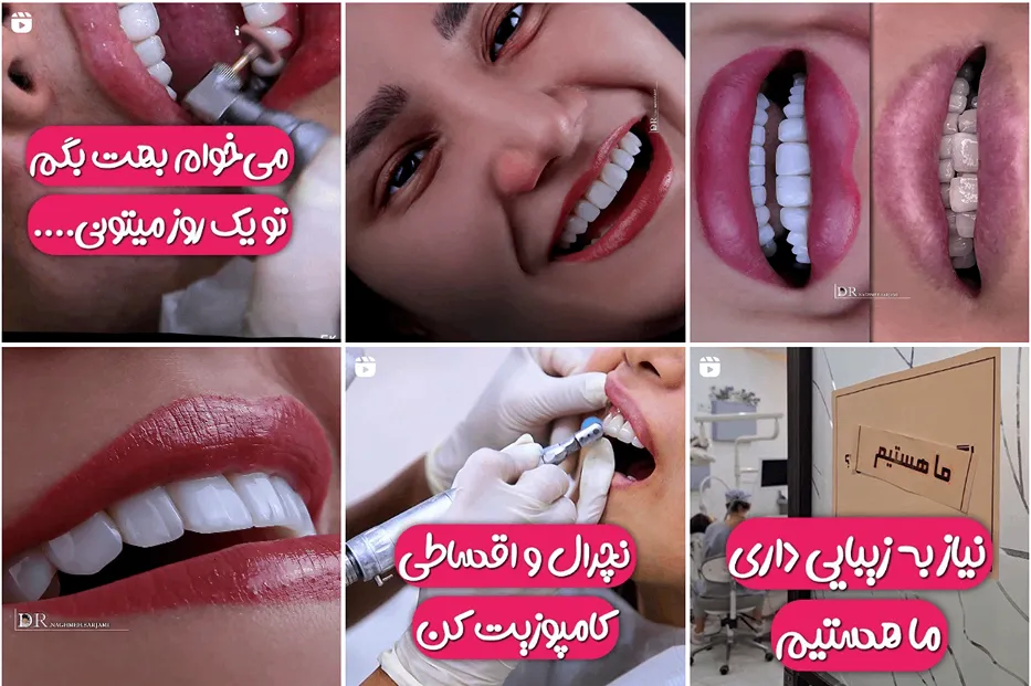 بلیچینگ دندان در مشهد توسط دکتر نغمه قابل انجام است