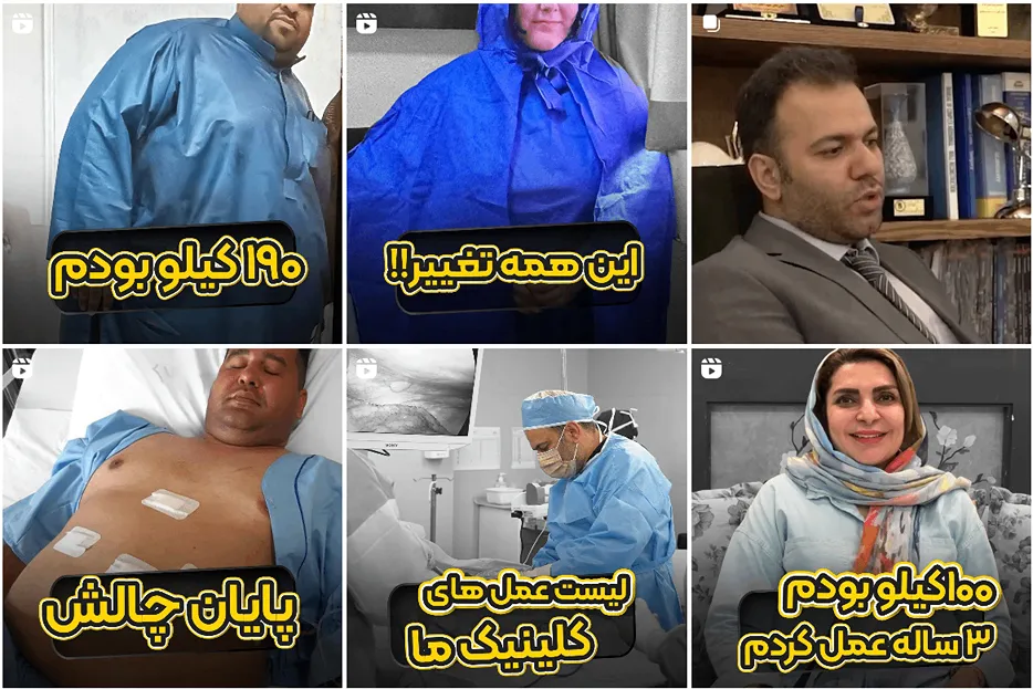 نمونه کار بهترین دکتر جراحی چاقی در مشهد را مشاهده میفرمایید.