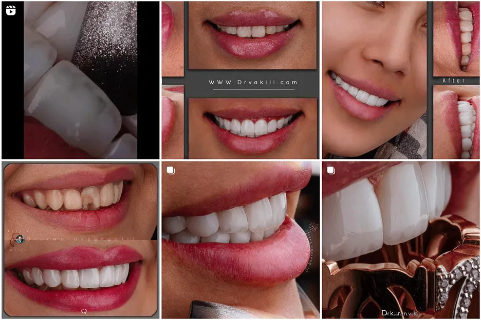 بلیچینگ در مشهد توسط دکتر وکیلی قابل انجام است