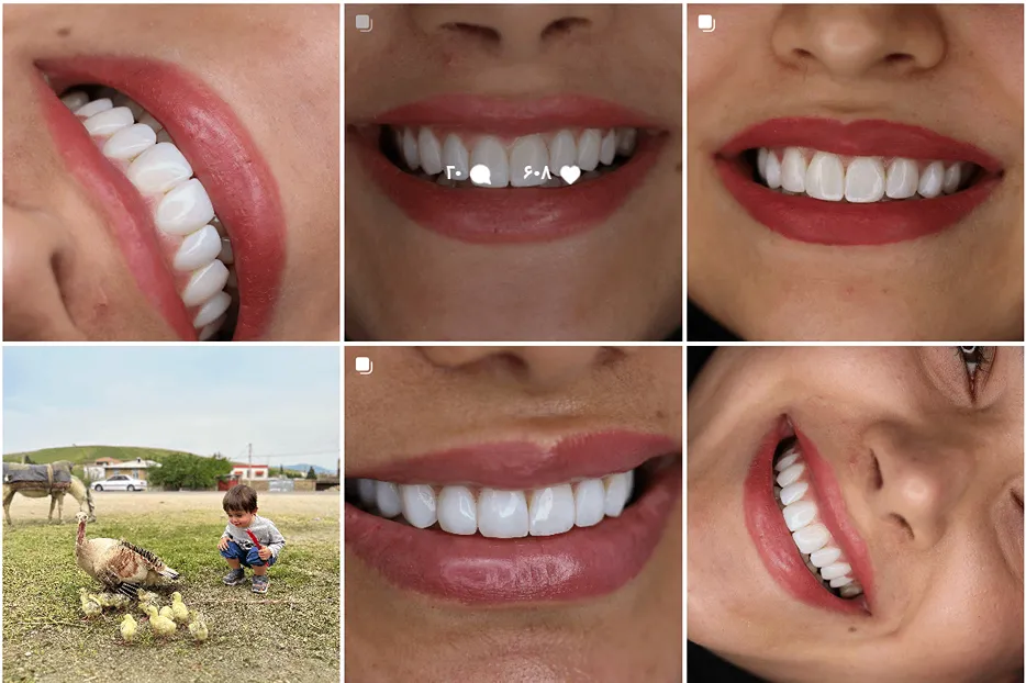 دندان پزشک زیبایی در مشهد توسط دکتر محمدپرست کاملا قابل اجرا است