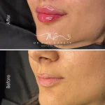 بوتاکس رشت در کلینیک دکتر کارگر کاملا قابل انجام است