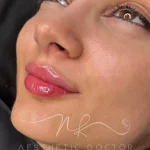 دکتر نینا از بهترین متخصصین بوتاکس رشت است