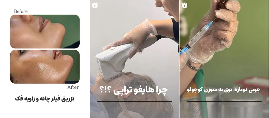 مزوتراپی در یزد توسط کلینیک زیبایی بهار کاملا قابل انجام است