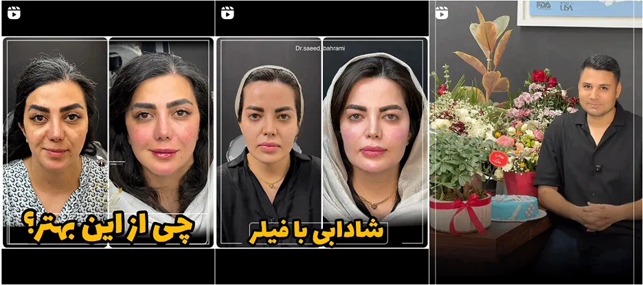 نمونه کار یکی از بهترین دکتر بوتاکس در کرمانشاه را مشاهده میفرمایید.