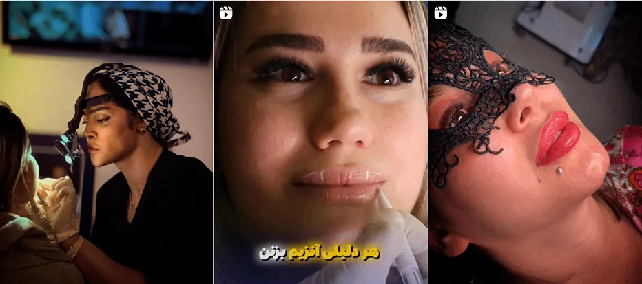 نمونه کار یکی از بهترین دکتر بوتاک در رشت را مشاهده میفرمایید.