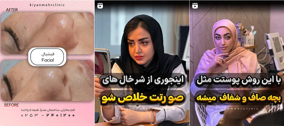 مزوتراپی در قم در کلینیک زیبایی کیان مهر کاملا قابل انجام است