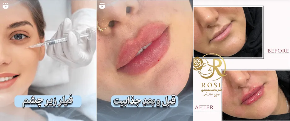 نمونه کار یکی از برترین دکتر بوتاکس در کاشان را مشاهده میفرمایید.