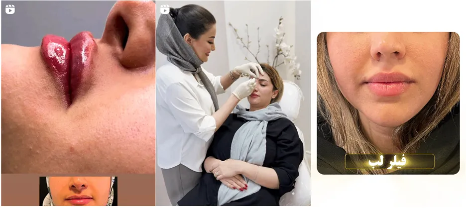 نمونه کار تزریق بوتاکس در اصفهان دکتر ناظمی را مشاهده میفرمایید.