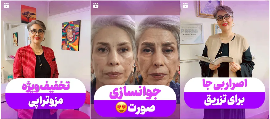 نمونه کار دکتر جوادیان یکی دیگر از بهترین دکتر بوتاکس در کرج را مشاهده میفرمایید.