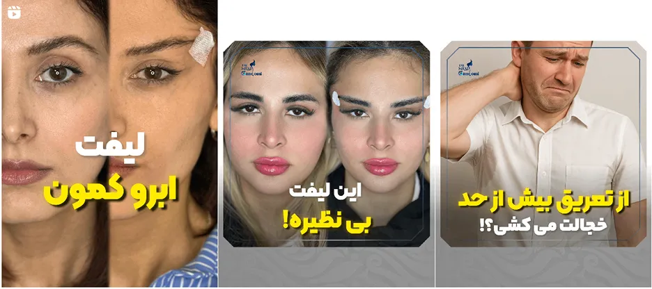 نمونه کار تزریق بوتاکس در تهران توسط دکتر گندمی را مشاهده میفرمایید.