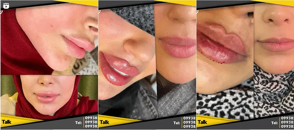 نمونه کار بهترین دکتر بوتاکس در تهران را مشاهده میفرمایید.