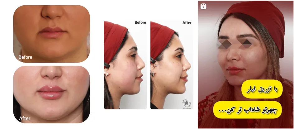 در این تصویر نمونه کار بهترین دکتر کلینیک زیبایی در رشت را مشاهده مییفرمایید.