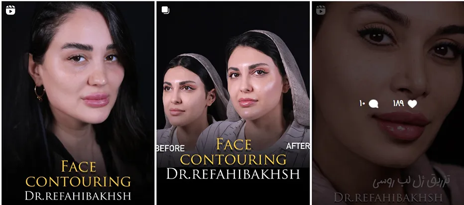 نمونه کار یکی از بهترین کلینیک زیبایی در رشت را مشاهده میفرمایید.