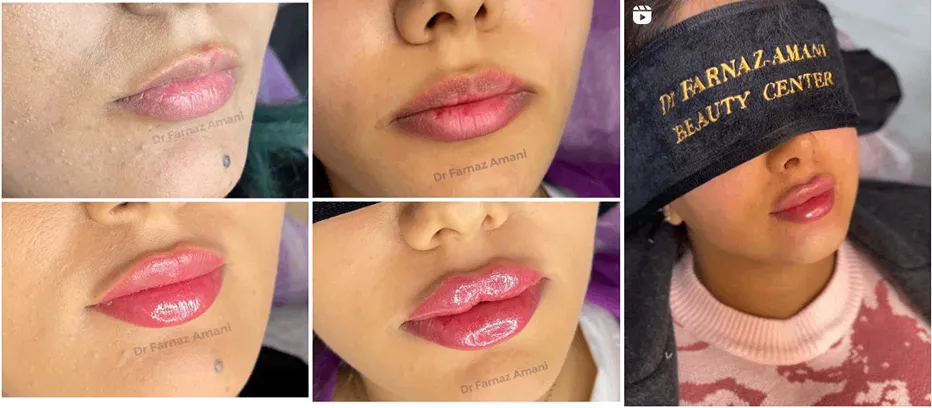 نمونه کار دکتر امامی از بهترین دکترین کلینیک زیبایی اردبیل را مشاهده میفرمایید.