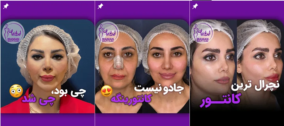 نمونه کار یکی از بهترین کلینیک زیبایی تهران را مشاهده میفرمایید.