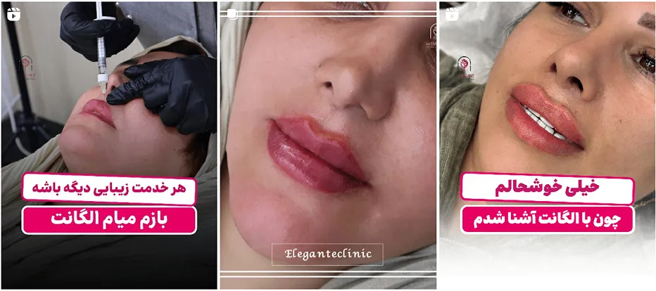 نمونه کار کلینیک الگانت از یکی از بهترین کلینیک زیبایی در ساری را مشاهده میفرمایید.
