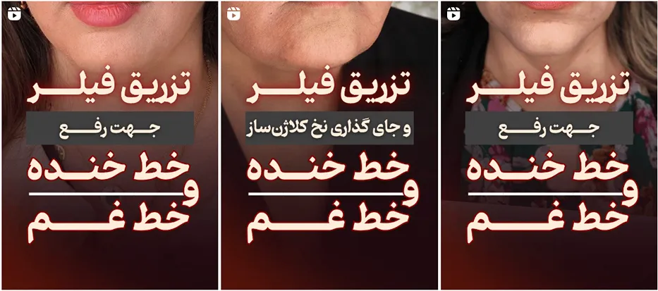 نمونه کار دکتر سرحدیان از بهترین متخصصین کلینیک زیبایی ارومیه را مشاهده میفرمایید.