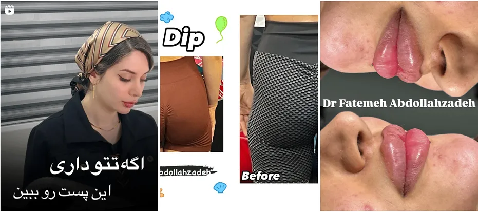 نمونه کار دکتر عبد اله زاده از بهترین متخصص کلینیک زیبایی در بوشهر را مشاهده میفرمایید.