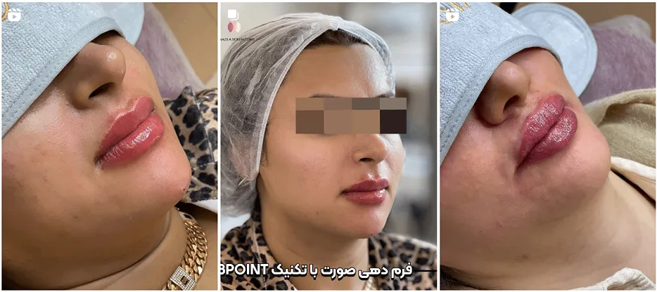 نمونه کار دکتر مقدم از بهترین دارنده های کلینیک زیبایی در بوشهر را مشاهده میفرمایید.