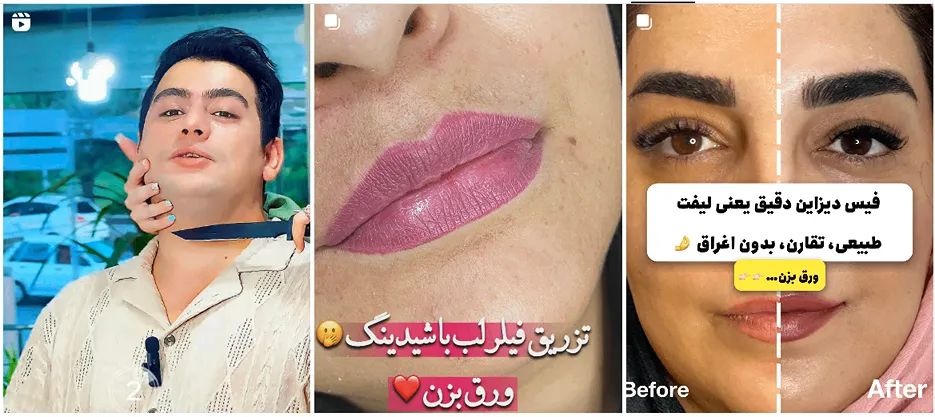 نمونه کار دکتر یحیی پور از بهترین دکتریرن کلینیک زیبایی ارومیه را مشاهده میفرمایید.