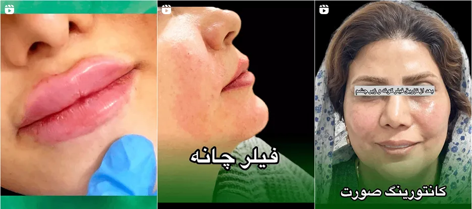 نمونه کار یکی دیگر از بروزترین کلینیک زیبایی در خرم آباد را در این قسمت مشاهده میفرمایید.