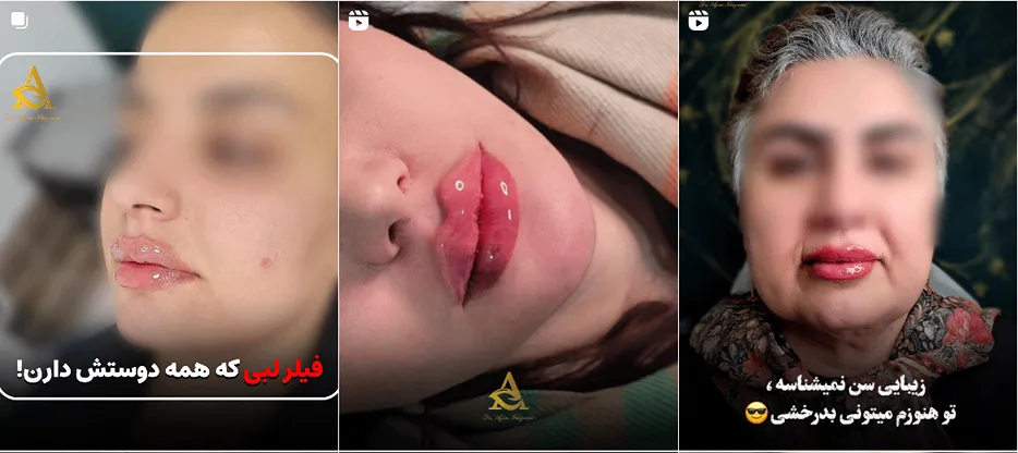 نمونه کار یکی دیگر از بهترین کلینیک زیبایی زنجان را مشاهده میفرمایید.