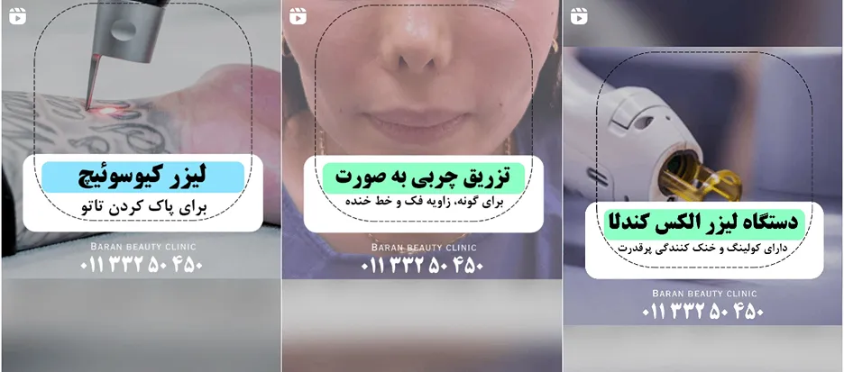لیزر در ساری در کلینیک زیبایی باران کاملا قابل انجام است