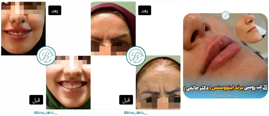 نمونه کار کلینیک زیبایی بینا را در این تصویر میتوانید مشاهده بفرمایید.