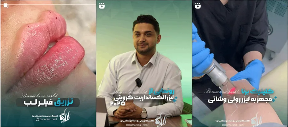 لیزر در رشت در کلینیک زیبایی برنا کاملا قبل انجام است