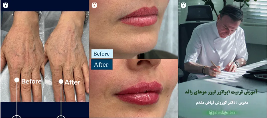 نمونه کار یکی دیگر از بهترین کلینیک لیزر رشت را مشاهده میفرمایید.