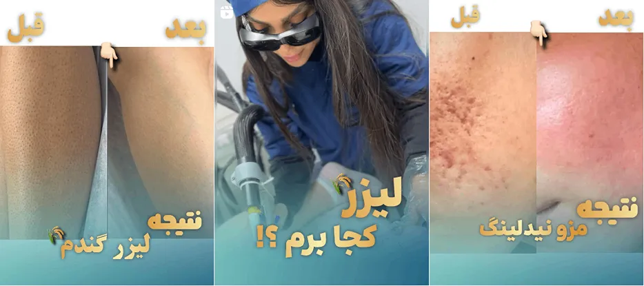 لیزر قزوین در کلینک گندم کاملا قابل انجام است