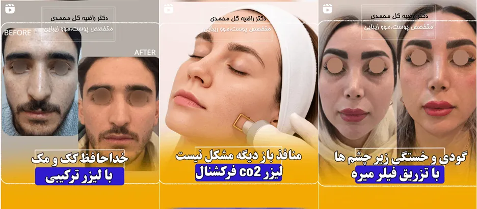 لیزر اردبیل در کلنیک دکتر گل محمدی کاملا قابل انجام است