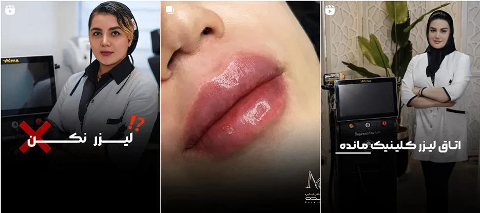 نمونه کار یکی از از بهرتین کلینیک لیزر در اراک را ماهده میفرمایید.