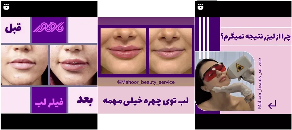 نمونه کار یکی از مجبوترین مرکز لیزر قم را مشاهده میفرمایید.