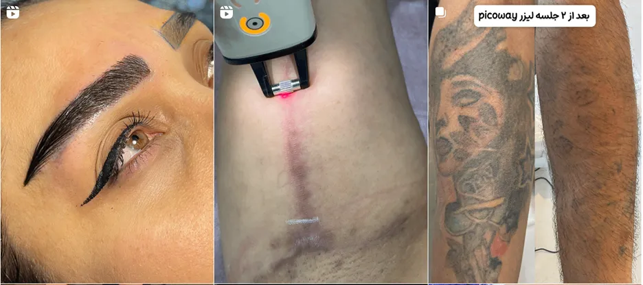 نمونه کار یکی از بهترین مرکز لیزر در تهران را مشاهده میفرمایید.