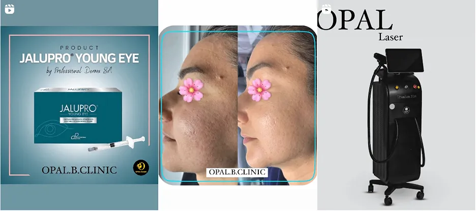 لیزر ارومیه در کلینیک زیبایی اپال کاملا قابل انجام است