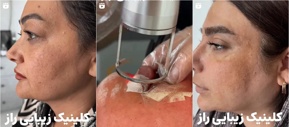 نمونه کار کلینیک زیبایی راز را در اینجام یتوانید مشاهده بفرمایید.