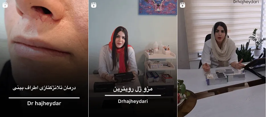 لیزر ساری در کلینیک زیبایی صدف کاملا قابل انجام است