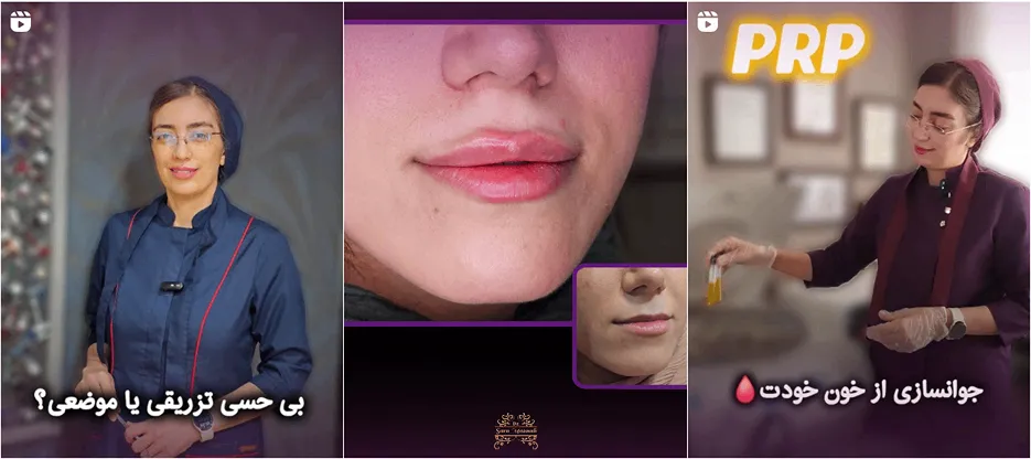 نمونه کار دکتر مسعودی از دارنده های بهترین کلینیک زیبایی کاشان را در اینجا نیز میتوانید مشاهده بفرمایید.