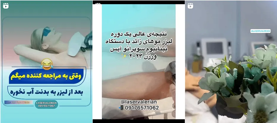 لیزر در شیراز در مرکز زیبایی والرین کاملا قابل انجام است