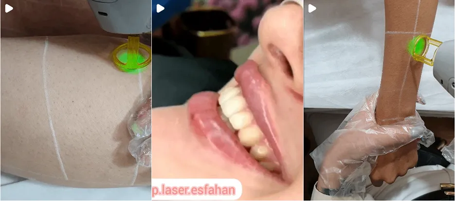 نمونه کار یکی دیگر از بهترین مرکز لیزر اصفهان را میتوانید مشاهده بفرمایید.