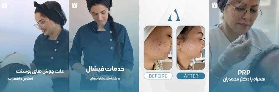 بهترین کلینیک و مرکز پاکسازی پوست در زنجان(فیشیال)+ 1404