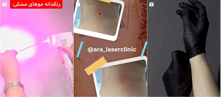 نمونه کار یکی از مجهزترین مراکز لیزر در گرگان را مشاهده میفرمایید.